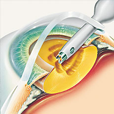 Iroc Zurich Cataract operation illustration
