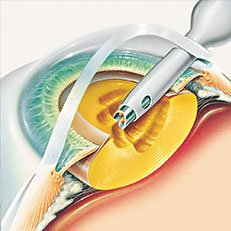 Iroc Zurich Cataract operation illustration