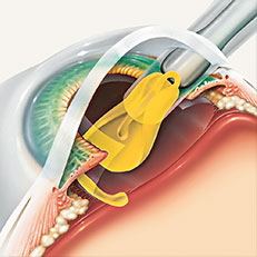 Iroc Zurich Cataract operation illustration