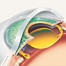 Iroc Zurich Cataract operation illustration